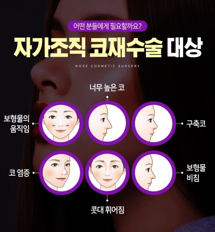 코재수술잘하는곳 찾는 이유는?