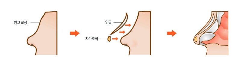매부리코성형수술, 매부리코의 형태 및 특성별 적합한 교정수술 방법을 확인해 보자.